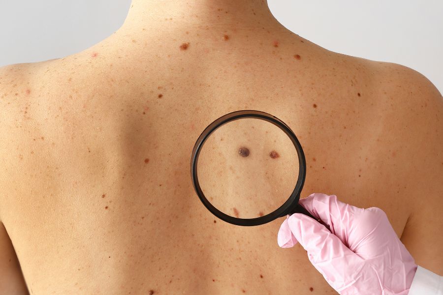 ABCDE das pintas: Como identificar alterações suspeitas