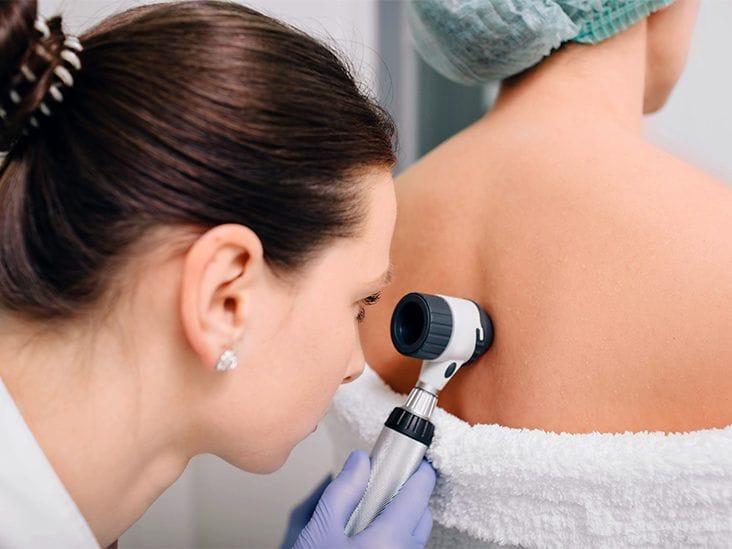 A imagem mostra uma dermatologista realizando um exame detalhado da pele de um paciente. A profissional está utilizando um dermatoscópio, um dispositivo que permite a visualização ampliada de lesões ou áreas específicas da pele. O paciente está sentado com as costas expostas, facilitando a inspeção minuciosa. A dermatologista está focada no exame, segurando o dermatoscópio com cuidado para garantir uma avaliação precisa. Este tipo de exame é comum na prática dermatológica para diagnosticar e monitorar diversas condições de pele, garantindo um atendimento detalhado e personalizado.